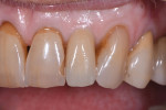 Five-year posttreatment smile photograph and close-up and left lateral close-up photographs of tooth No. 10.