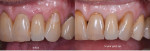 A comparison of the immediate postoperative and 5-year postoperative left lateral close-up photographs demonstrates how dental implants can provide a long-lasting, stable solution, even in older patients.