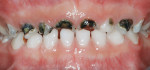 Figure 1  Severe early childhood caries.