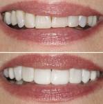 Fig 1. Before/After: Patient before IB treatment (top). Patient after IB treatment using Beautifil Flow Plus® (bottom).