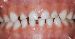 Figure 2  White spots shown in a high-risk patient.