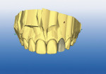 Figure  2  DIGITIAL CAPABILITIES While the centrals were milling, the remaining incisors were designed in tandem sequence for proficient design and milling time (approximately 7 to 9 minutes milling time per tooth).