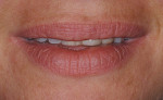 Figure 1  The patient’s lip dynamics show how she has conformed to her comfort level.
