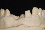 Figure 6  The prepared tissue cast shows the amount of reduction of tooth preparations Nos. 6 and 8 and the amount of missing bony architecture.