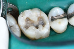 Occlusal view of the fiber-reinforced composite after it was closely adapted to the cracked dentin and light cured.