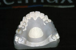 Figure 6  3-D printed polycarbonate partial framework ready for an IPS e.max crown.