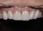 Pretreatment retracted photograph with the teeth apart and close-up maxillary view of the existing maxillary porcelain veneers showing discoloration, marginal staining, and repairs made with composite resin.