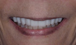 Posttreatment smile photograph and retracted close-up maxillary view of the final lithium disilicate veneers (IPS e.max® Press, Ivoclar) after cementation (Variolink Esthetic Neutral, Ivoclar), cleanup, and final polishing.