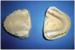 Figure 1  The upper and lower casts showed extreme wear on the denture teeth.