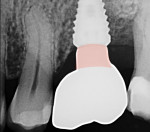 Fig 4. The lab technician created a type 1 prosthesis by following the stock healing abutment soft-tissue profile shown in pink.