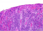 Fig 2. Low-power (x100 magnification) histopathology of dense inflammatory infiltrate.