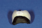 Figure 5  The porcelain coverage to the full extent of the marginal area. Also with an ideal contour build-up, grinding is kept to a minimum, which is evidenced here by the areas untouched with grinding instruments.