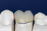 Figure 11   Adding a few maverick colors like the one on the mesio-occlusal cusp for contrast gives the restoration a more natural appearance.