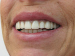 Figure 1  The existing smile with maxillary complete and mandibular implant-retained overdenture. Note the Class II relationship.