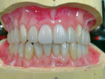 Figure 7  After clinical esthetic wax try-in, verification denture waxing was completed and prepared for investing.