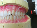 Figure 8  After clinical esthetic wax try-in, verification denture waxing was completed and prepared for investing.