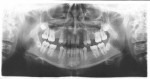 Figure 20  Preoperative panoramic radiograph demonstrating the patient’s congenitally missing teeth.