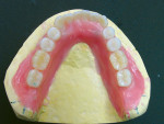 Figure 9: Occlusal view of completed maxillary and mandibular waxed dentures. Maxillary has a custom palate that duplicates the patient’s natural rugae.