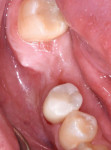 (3.) Pretreatment view of a healed mandibular first molar extraction site.