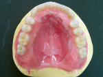 Figure 10  Occlusal view of completed maxillary and mandibular waxed dentures. Maxillary has a custom palate that duplicates the patient’s natural rugae.
