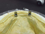 Figure 12  Mandibular implant analogs with Preci-Clix attachments.