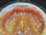 Figure 14  Maxillary denture mold with five-color gingival characterization. A layer of color 55 was placed in the labial unattached tissue of the positive mold, where there are more vascular colors.