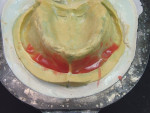 Figure 15  Maxillary denture mold with five-color gingival characterization. A layer of color 55 was placed in the labial unattached tissue of the positive mold, where there are more vascular colors.