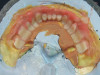 Figure 5  Three-month postoperative image of the upper and lower arch implant abutments.