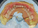 Figure 16  Mandibular denture molds with five-color gingival characterization. As in the maxillary, a layer of color 55 was placed in the area of the labial sulcus unattached tissue.
