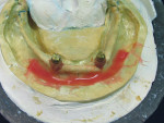 Figure 17  Mandibular denture molds with five-color gingival characterization. As in the maxillary, a layer of color 55 was placed in the area of the labial sulcus unattached tissue.