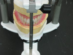 Figure 18  After processing and deflasking, the dentures were re-mounted with casts on the Stratos 100 articulator to verify occlusal contacts.