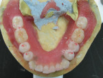 Figure 19  Using articulating ribbon, occlusal contacts were verified for lingual contact occlusion.