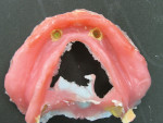 Figure 24  The Ivocap Injection processed dentures were deflasked and the intaglio surface was checked. Block-out around the Preci-Clix attachments would be removed during finishing.