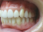 Figure 25  Finished and polished maxillary and mandibular complete-denture prosthetics in the oral environment.