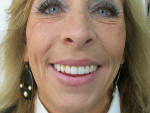 Figure 26  Facial view of new smile line with improved anterior esthetics.