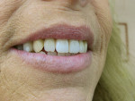 Figure 27  Right facial view of the smile line and anterior esthetics.