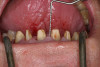 Figure 3  Lingualized posterior occlusion: maxillary complete denture and mandibular implant stress-broken overdenture.
