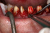 Figure 6  Filou 28 Denture set-up system: mandibular teeth-jig assembly. Mondial<sup>®</sup> teeth.