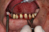 Figure 10  Mandibular metal-reinforced overdenture with ball-abutment retentive elements picked up intraorally.