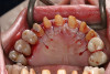 Figure 12  Edentulous maxilla: implant-supported fixed partial denture with eight Nobel Biocare Select<sup>®</sup> dental implants. Porcelain-fused-to-metal cross-arch stabilized substructure and individually bonded all-ceramic restorations.