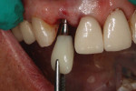 (22.) The previously fabricated screw-retained provisional restoration was inserted into the implant and fixated with a prosthetic screw, then PTFE tape was used to block the screw head and the access hole was sealed with composite.
