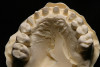 Figure 13  Radiographs of edentulous maxilla: dental implant fixed partial denture.