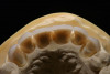Figure 14  Radiographs of edentulous maxilla: dental implant fixed partial denture.