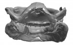 Fig 3. The posterior perspective of the scanned dentures shows the border molding and wash impression of the existing dentures.