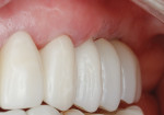 Fig 8. Buccal view following delivery of implant-supported fixed partial denture.