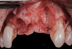 Fig 11. Severe buccal defects were noted following tooth extraction and elevation of a full-thickness flap.