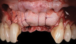 Fig 14. Buccal view of stabilization.