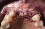 Fig 16. Occlusal view following primary closure.