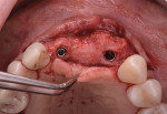 Fig 19. Occlusal view following implant placement.