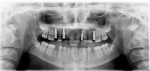 Figure 26  Panoramic radiograph taken immediately after implant placement.